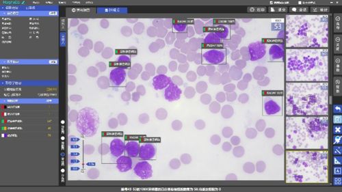 AI赋能血液学 细胞技术研发与应用开启形态诊断新纪元